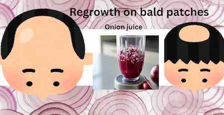 which is better for bald patches onion juice or caster oil