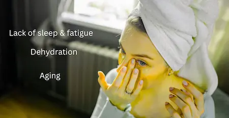 How to Get Rid of Dark Circles Naturally